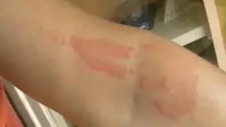 Histaminic reaction across the lymph vessels on patient's forearm after treatent