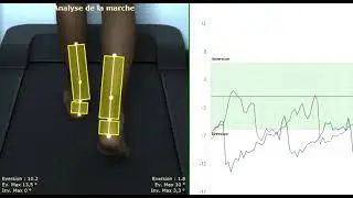Analyse de la marche avec logiciel Clinique OPS : intoeing gauche