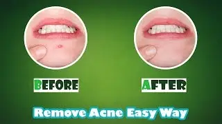 How To Remove Acne/Pimples In PhotoShop