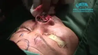 Extirpación carcinoma basocelular nasal y reconstrucción/ Nasal BCC removal and reconstruction