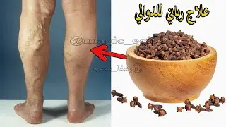 جعله الله علاج دوالي الساقين والأوردة العنكبوتية خلال اسبوع1 فقط