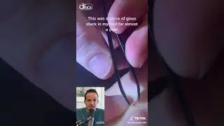DOCTOR REACTS! GLASS STUCK IN FOOT FOR ONE YEAR!😱 #shorts #reaction