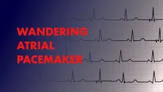 Wandering Atrial Pacemaker -  EKG (ECG) Interpretation