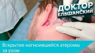 Вскрытие нагноившейся атеромы за ухом