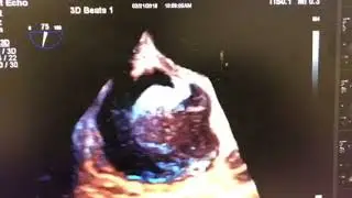 2D/3D-TEE of a huge RA thrombus attached to the atrial septum