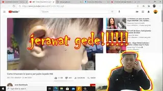 Jerawat batu terbesar [Reaction] Blackhead Satisfying