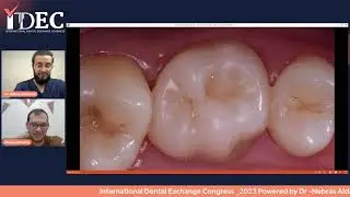 DIRECT COMPOSITE  - ONLAY - OVERLAY  , Dr Ahmed Alhakeem 🇪🇬