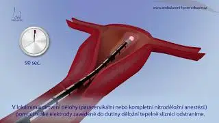 Radiofrekvenční ablace endometria