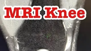 MRI Knee