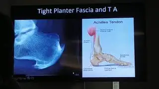 Frozen shoulder, plantar fascitis