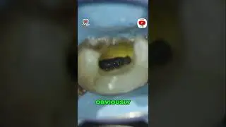Mastering Endodontics  Finding the Perfect Balance 🦷✨