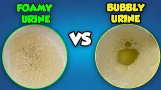 Foamy Urine vs Bubbles in Urine: What is the Difference?