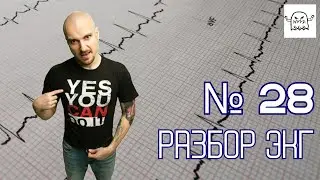 Разбор ЭКГ № 28