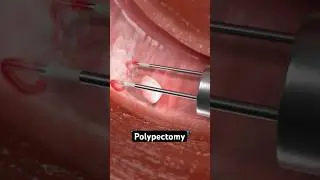 Removing a polyp from your uterus (3D Animation)