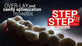 Step-by-step. Overlay preparation and cavity optimization protocol.
