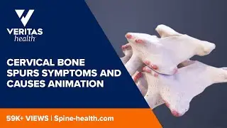 Cervical Bone Spurs Symptoms and Causes Animation