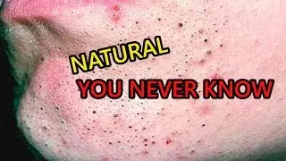 5 DIY Natural Ways to Get Rid of Blackheads YOU NEVER KNOW