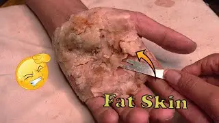 How to removal skin | callus removal skin flakes #49