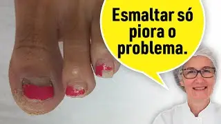 ESMALTAR UNHA COM FUNGO SÓ PIORA O PROBLEMA