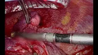 Intraoperative Management of Pulmonary Artery Bleeding with Hemostatic Agents