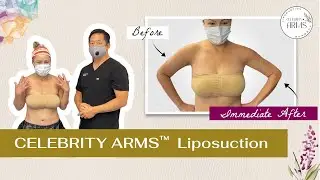 Celebrity Arms™ Liposuction with Dr. Su | Immediate Results | Minimal Downtime | Artlipo