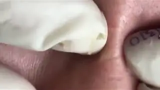Acne Treatment Blackhead Extractions Popping #83