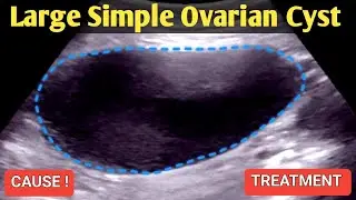 Large Simple Ovarian Cyst - Ultrasound