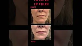 Are you looking for fuller lips, rejuvenated skin, or enhanced chin? Give us a call!  #cosmeticderm