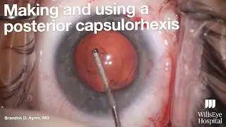 IOL Exchange Using a Posterior Capsulorhexis for Implant Fixation