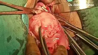 Cornual myomectomy at NDVH with audio