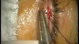 surgical technique of lateral tarsorrhaphy by Prof Dr Selçuk YILMAZLAR