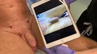 SEE HOW MUCH BIGGER  AND THICKER YOU CAN GET YOUR PENIS GIRTH WITH FAT INJECTIONS | Dr. Jason Emer