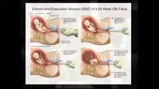 Pro-choice?