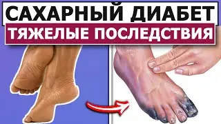 💊Что такое ДИАБЕТ?