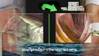 #ดูแลลำใส้เป็นส่วนสำคัญอย่างหนึ่งในการรักษาสุขภาพร่างกาย