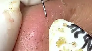 Выдавливание черных точек и прыщей 2023 Relax Every Day with Loan Nguyen Official 