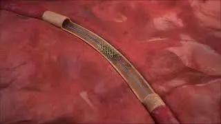 Angioplasty Stent Animation