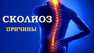 Сколиоз, причины сколиоза. Целитель Виктор Руденко