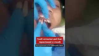 Tooth knocked out of place put back in position; Tooth Avulsion; Dr. Srishti Bhatia