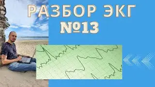 Разбор ЭКГ №13