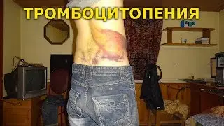 Тромбоцитопения: последствия падения и ушиба