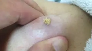 Огромный прыщик 18+
