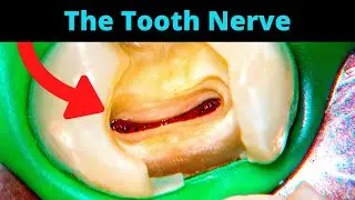 Tooth Cavity - Partial Pulpotomy Procedure (Healed Without a Root Canal!) - Dr. Ricucci