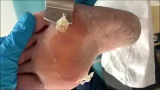 Callus removal from feet&Foot scraping dead skin【TD Foot care】#stress