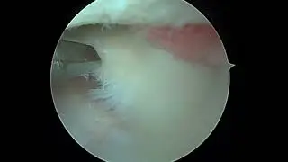 L lateral menisectomy and medial chondroplasty 2 9 23 DE