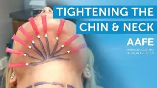 Using Solid Filler Smooth PDO Threads to Tighten the Submental Area and Neck | AAFE