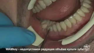 Применение WamKey - снятие коронки 005 - (коронковые ключи WAMKey отзывы)