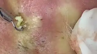 They squeeze out pimples, blackheads and blackheads. Relax - Sticky - ASMR.