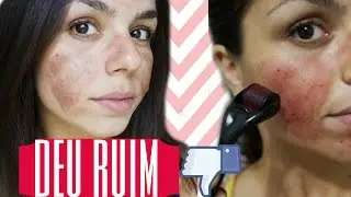 DERMAROLLER EM CASA CUIDADO!! | 💛Lorena Rodrigues💛