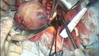Total Abdominal Hysterectomy. Uterine fibroids